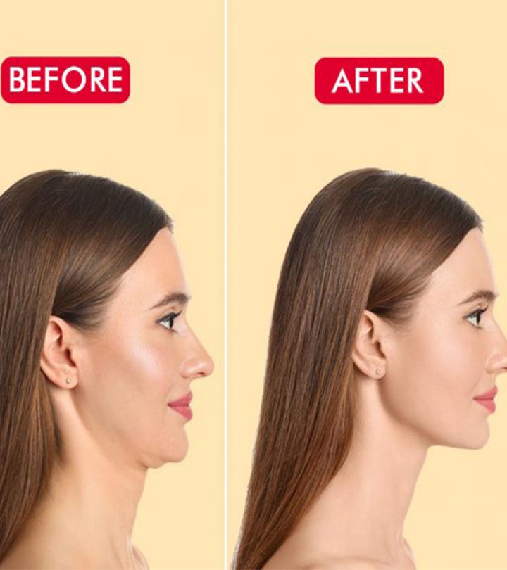 A girl showing her neck before and after results