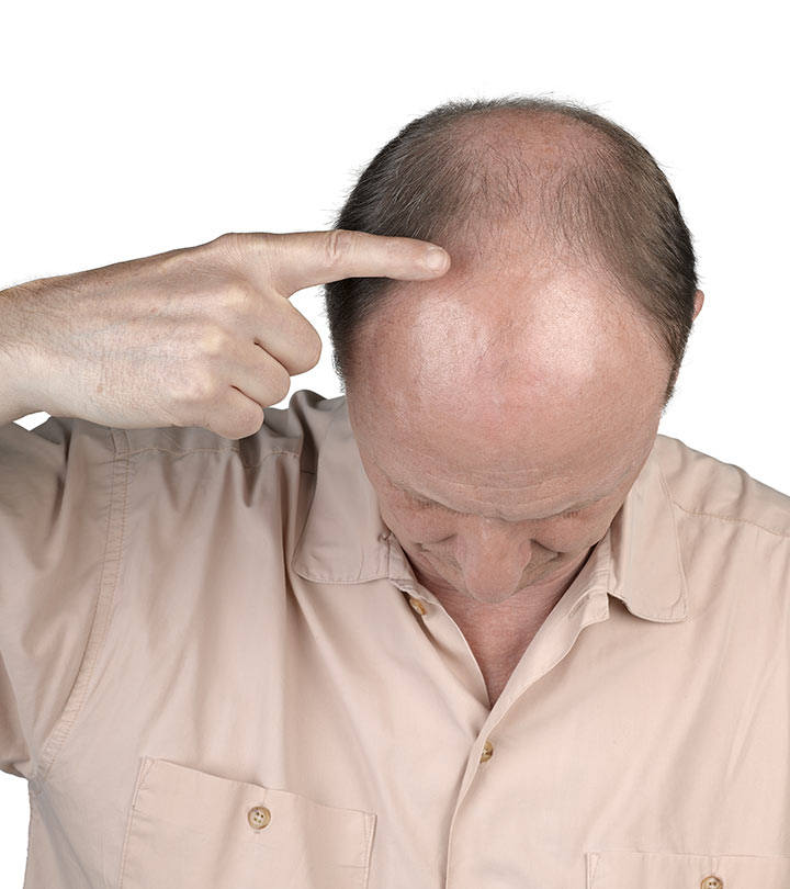 A man with frontal hair loss