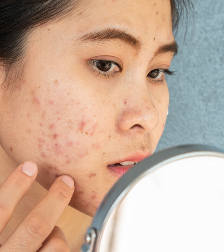 Woman With Fungal Acne On Face