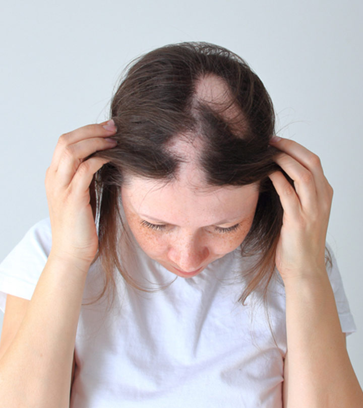 Women With Alopecia Areata Showing Hair Loss On Scalp Women With Alopecia Areata Showing Hair Loss On Scalp