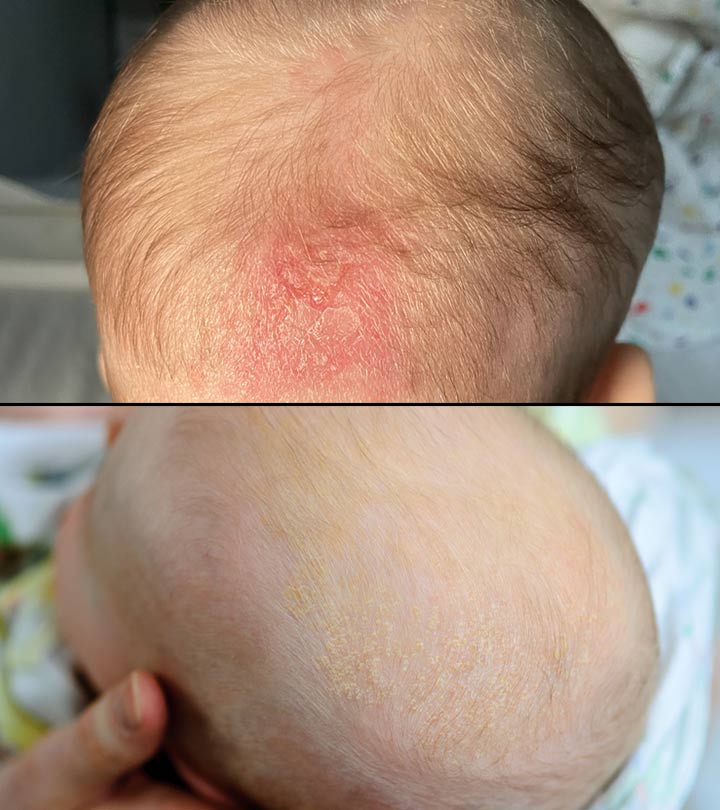 Cradle Cap Vs Dry Scalp