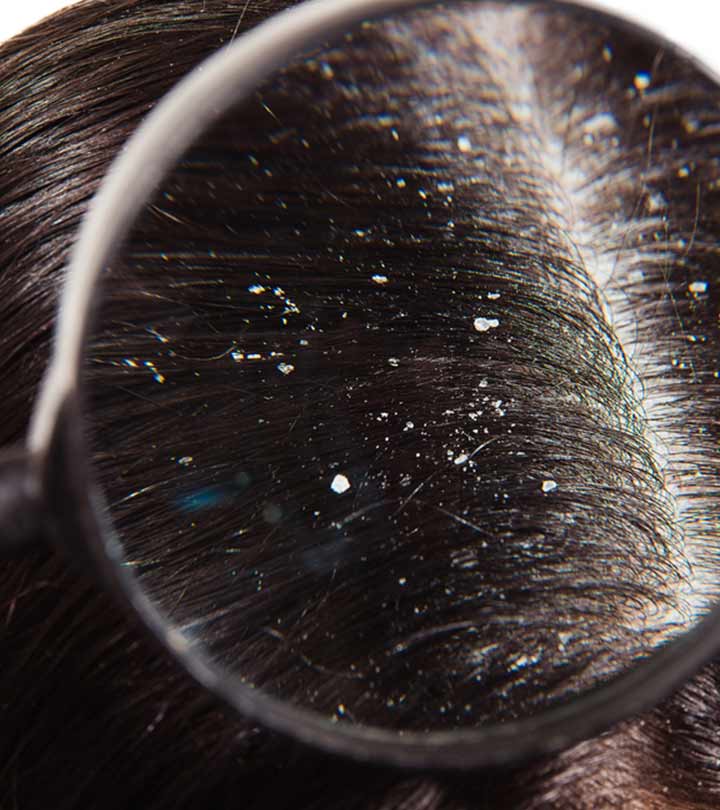 Dandruff Vs. Dry Scalp