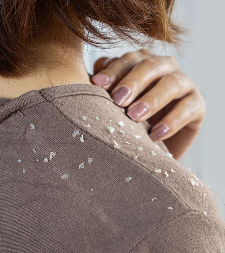Women Suffering From Dandruff flakes in winter Women Suffering From Dandruff flakes in winter