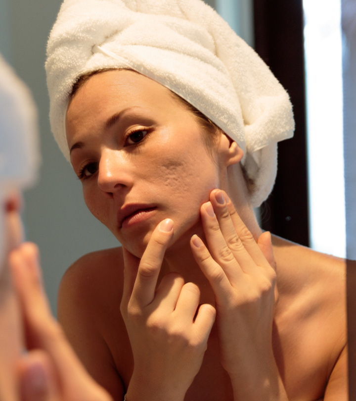 Woman With Pockmarks On Face