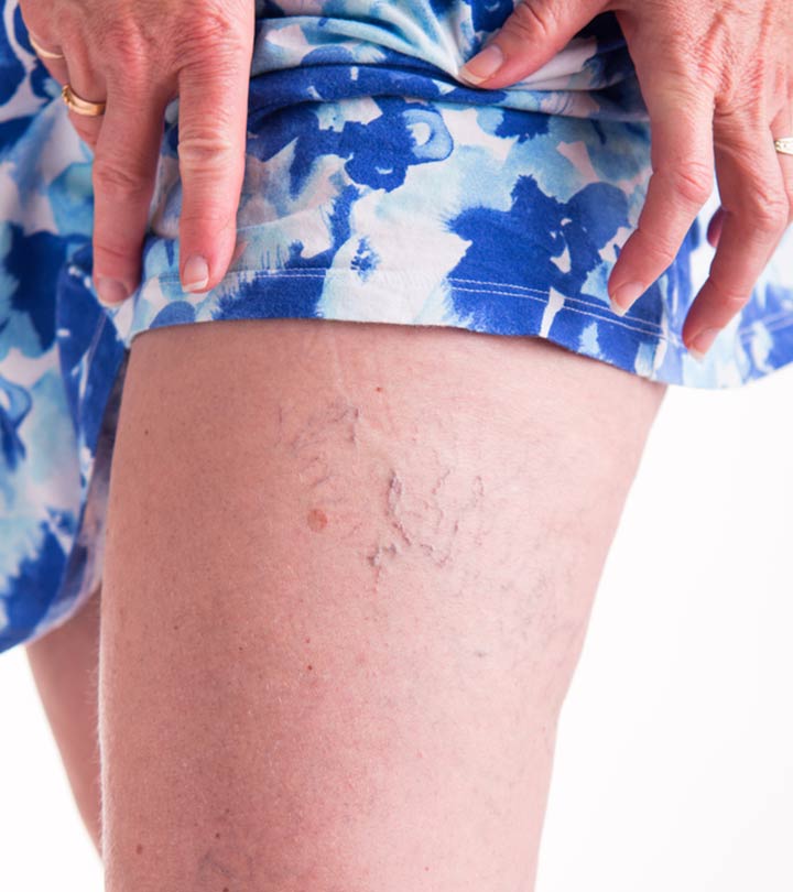 Women showing spider veins on their thigh