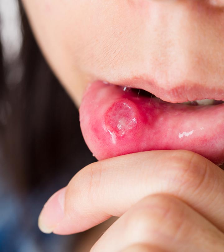 Woman Applying Honey To Heal Canker Sores Woman Applying Honey To Heal Canker Sores
