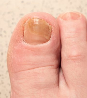 Toenail fungus on a woman’s foot Toenail fungus on a woman’s foot