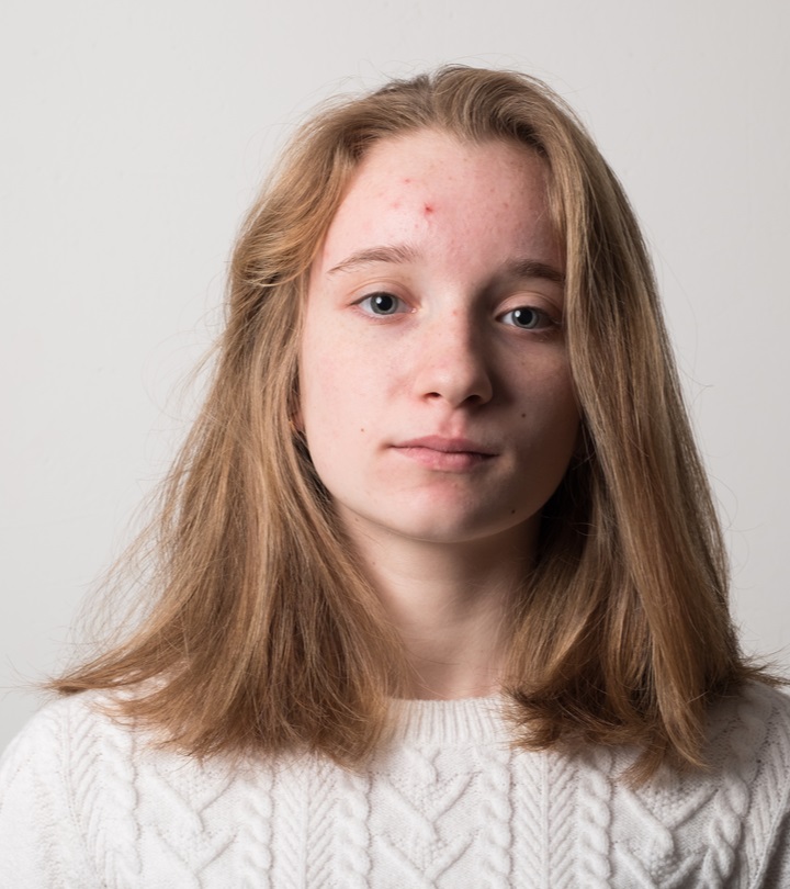 A girl with facial acne