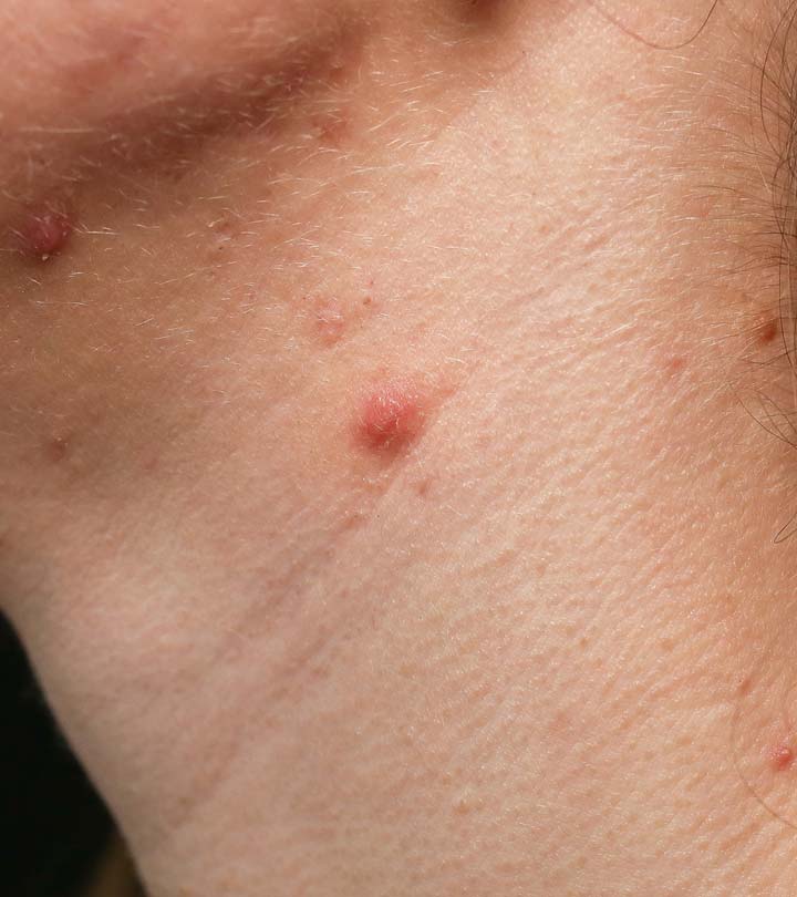 Person With Pimples On Their Neck