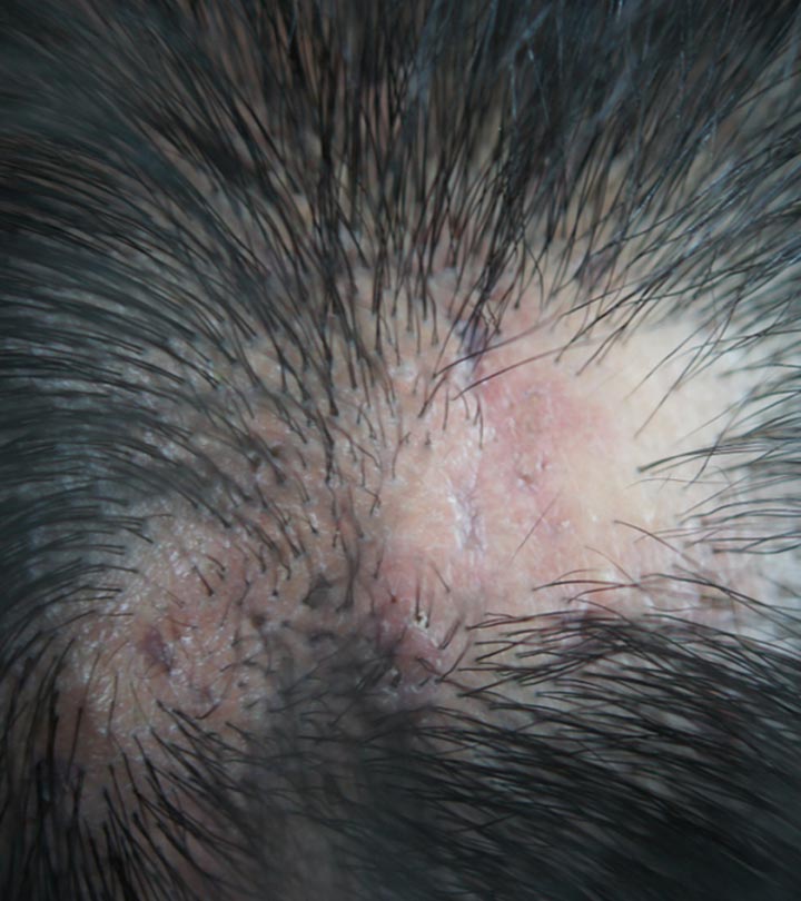Scalp With Visible Signs Of Scarring Alopecia Scalp With Visible Signs Of Scarring Alopecia