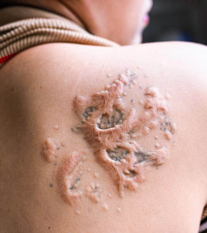 Woman With Tattoo Rash