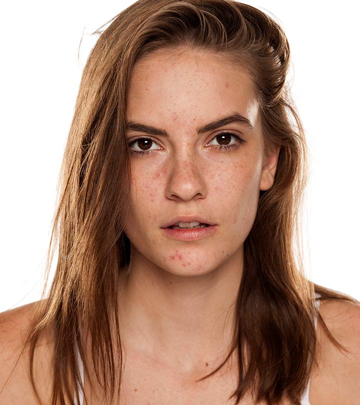 A girl with some PCOS acne on her face A girl with some PCOS acne on her face