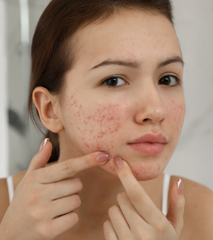 Women showing their face acne