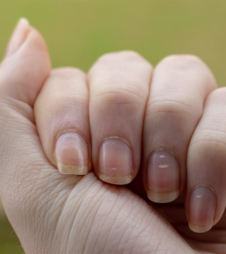 Women Experiencing White Spots On Nails