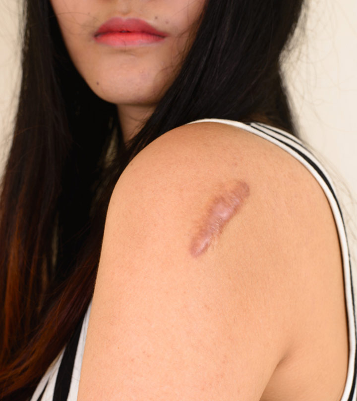Skin Lesions On A Women Skin Lesions On A Women