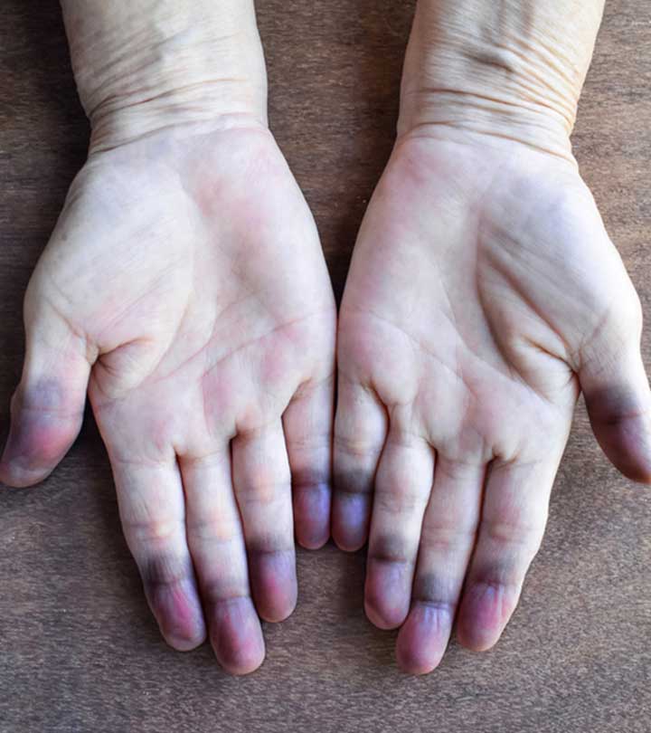 Person With Cyanosis